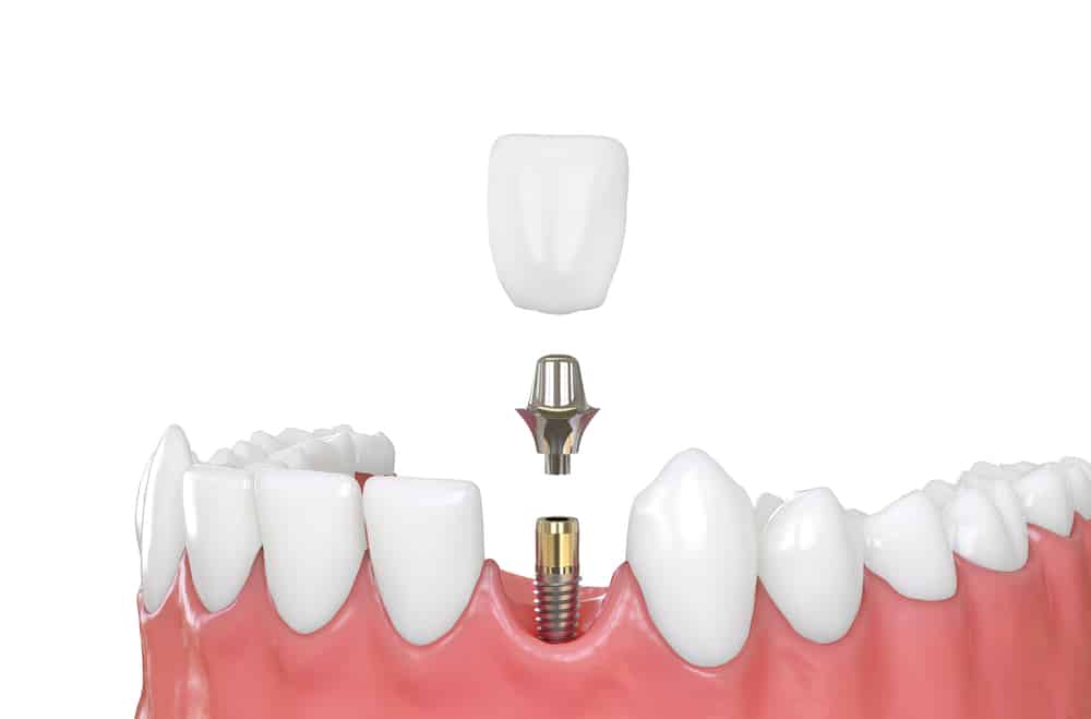 routine dental care, dental implants cost
