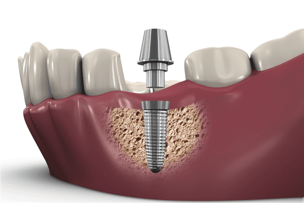 dental implant coverage, routine dental care, federal medicare program