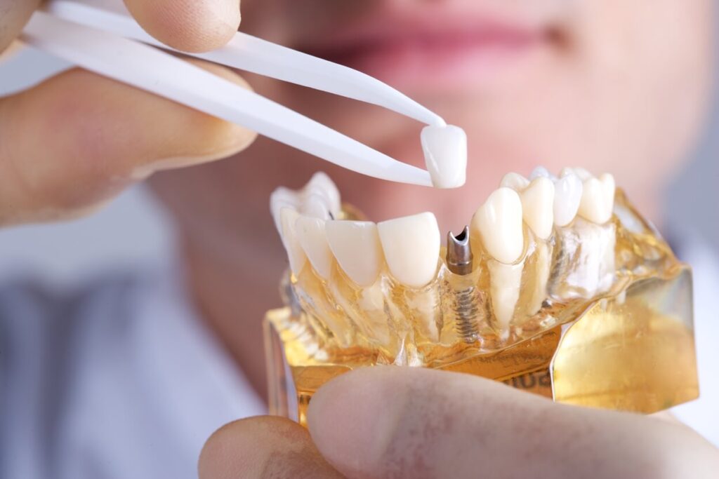 Will Unitedhealthcare Pay For Dental Implants